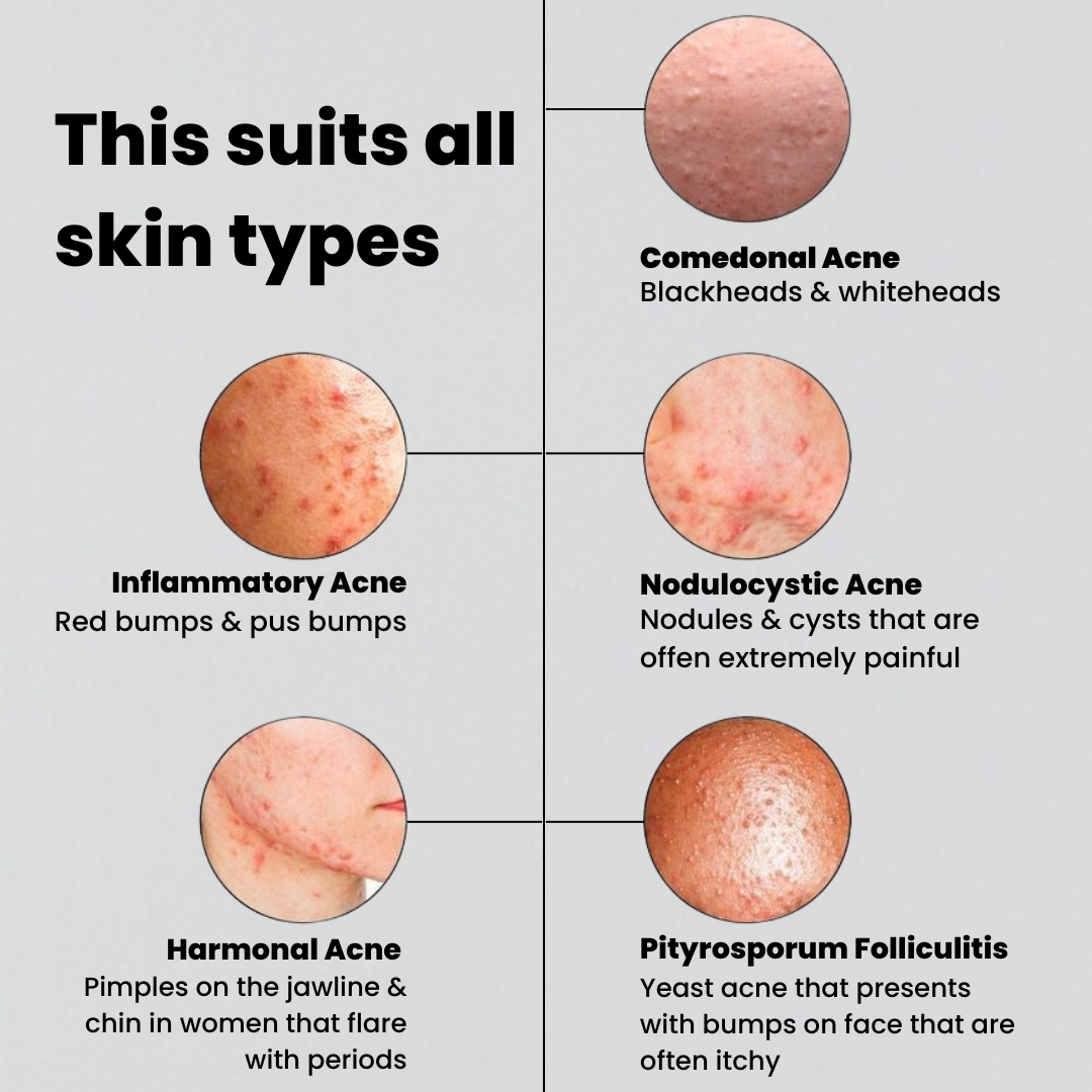ACNE Solution